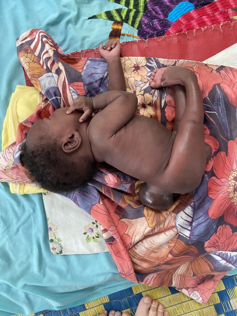 Baby Jok had surgery at CURE’s Uganda hospital last August to treat spina bifida (credit: Jenny Davies)