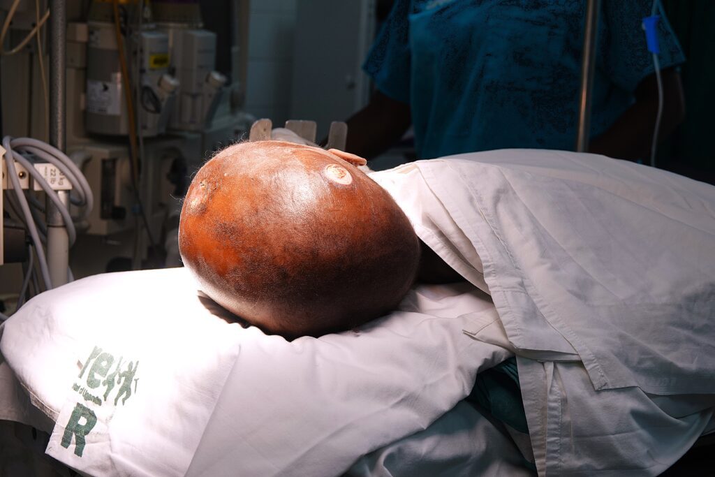 Due to hydrocephalus, Godfrey’s head swelled another 6cm (credit: Damalie Hirwa)