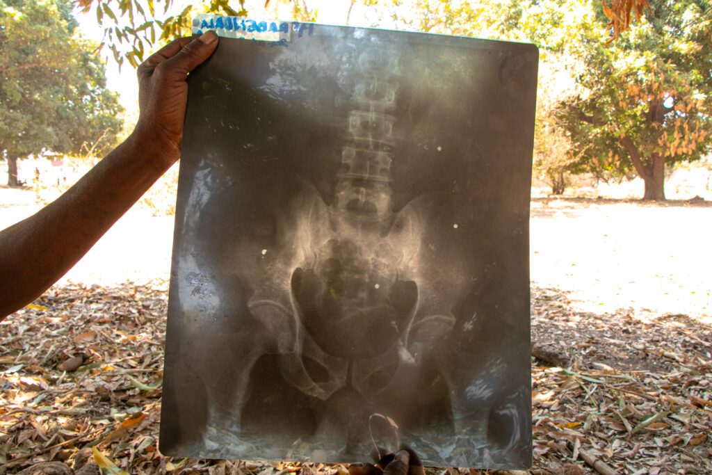 A hospital x-ray reveals bullets and fragments in Bendalana’s body (credit: A.Gino Randrianasolo)