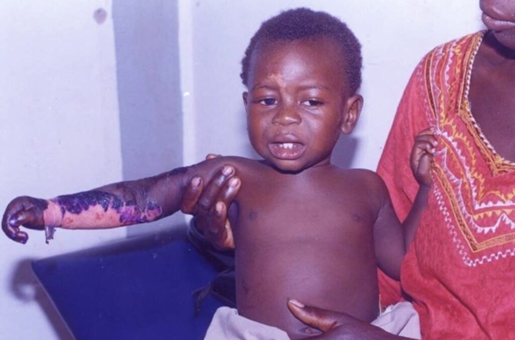 5 months after the accident (credit: Peter Marshall)